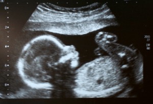 Ultrasound image of fetus at 22 weeks