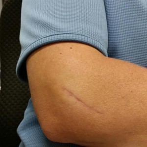 Elbow surgery left a scar, but removed the tennis elbow pain from this elbow.