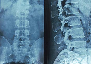 spine x-rays help spine surgery research