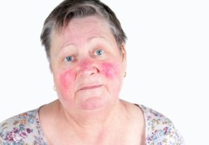 woman with skin condition rosacea