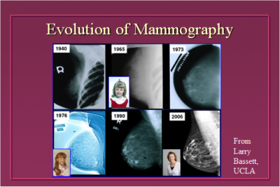 Mammography today is far more advanced, and now includes tomosynthesis (3D mammogram). 