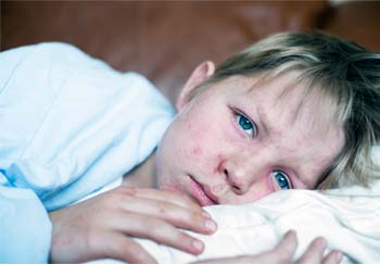 school-age boy with a rash from measles during the measles outbreak