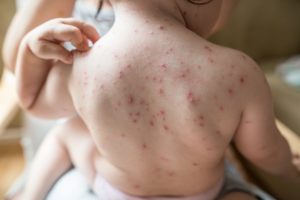 child with chickenpox all over their back