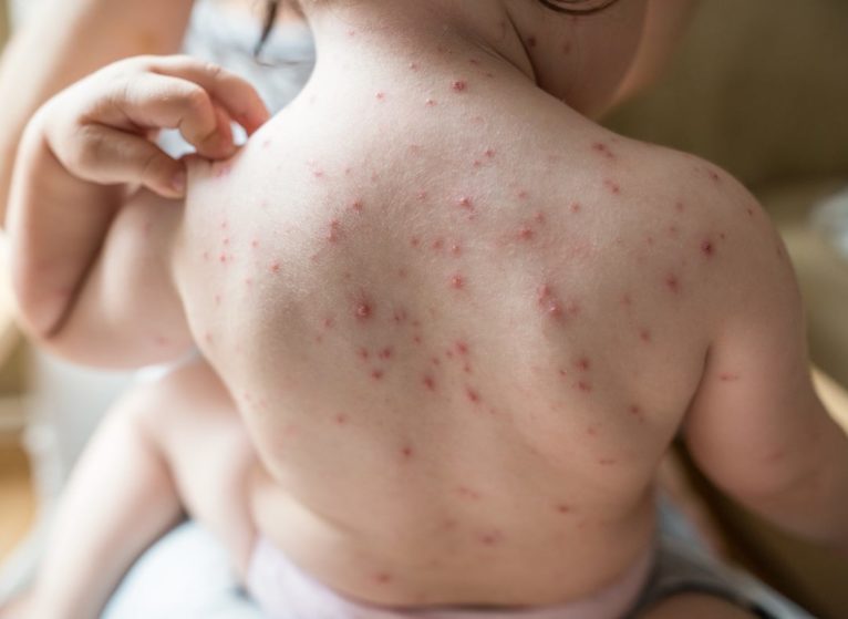 child with chickenpox all over their back
