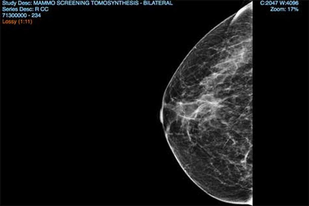 mammogram visual