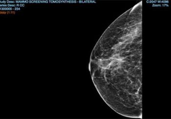 mammogram visual