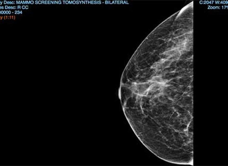 mammogram visual