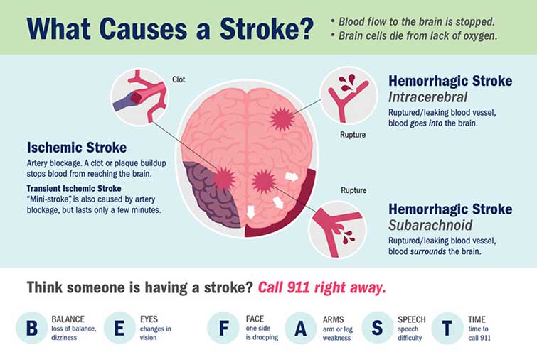 What Causes a Stroke? How Different Types of Strokes Happen