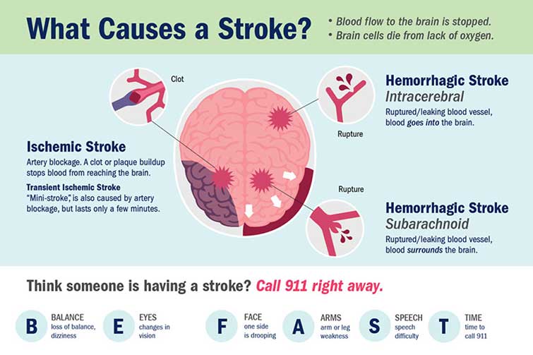 stroke causes