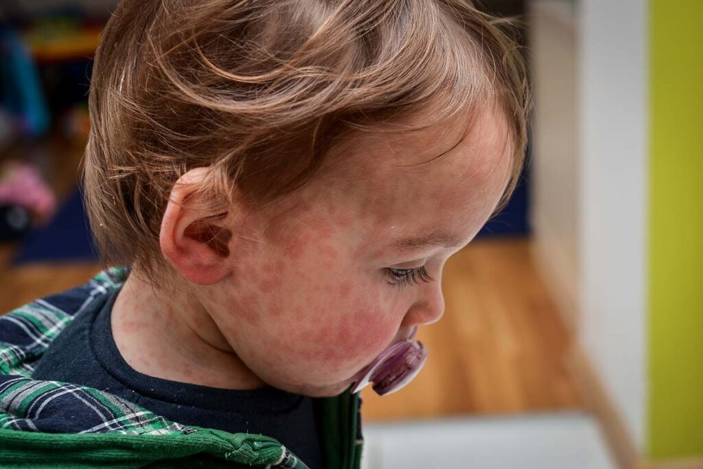A baby with a measles rash on their face