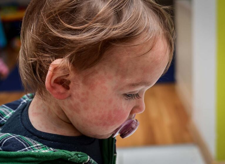 A baby with a measles rash on their face