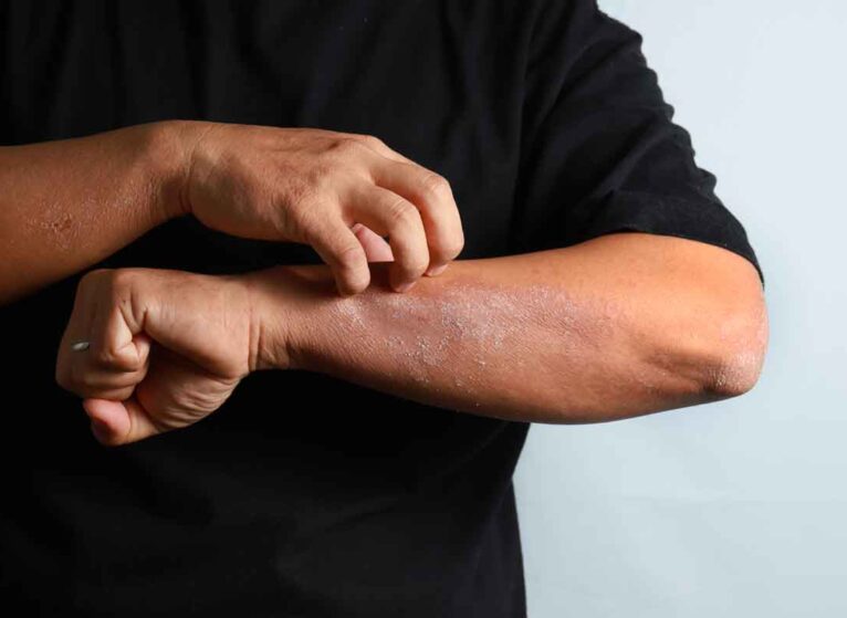 man wondering if his itchy skin is cancer