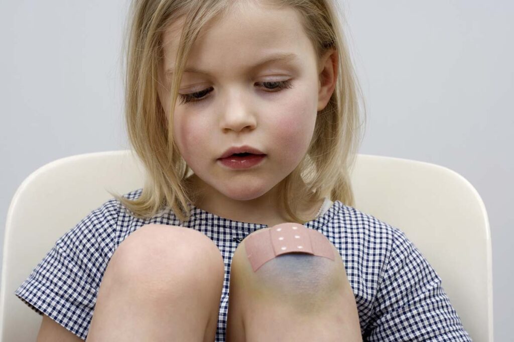 Little girl with bruises on knees