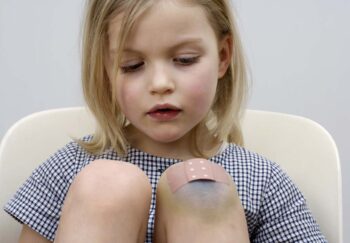 Little girl with bruises on knees