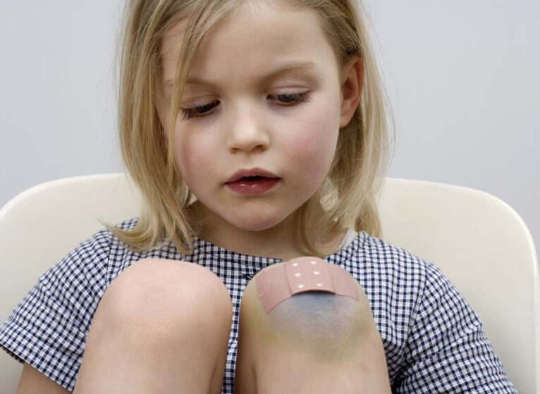 Little girl with bruises on knees