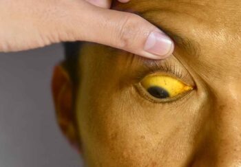 this man's yellow eyes could be a symptom of bile duct cancer