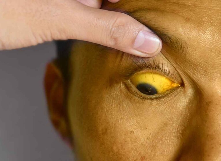 this man's yellow eyes could be a symptom of bile duct cancer