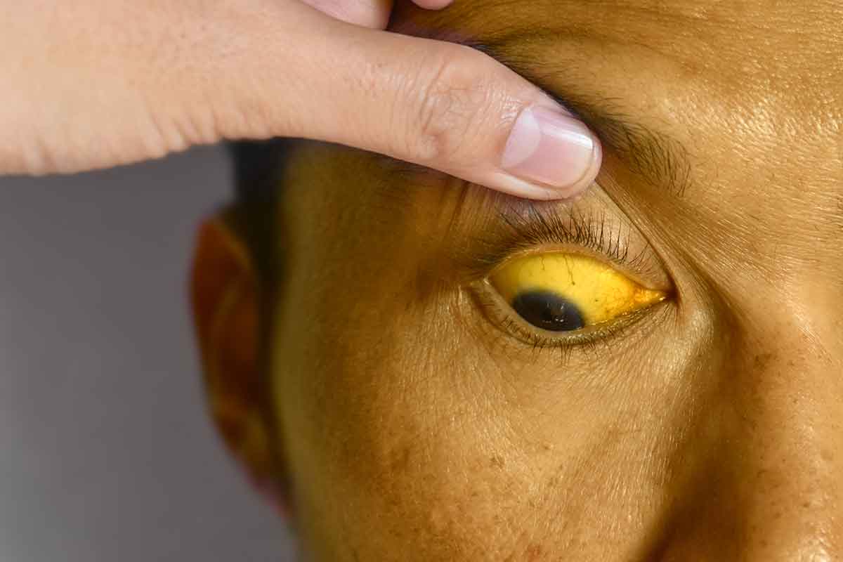 Look Yellow? You Might Have Cholangiocarcinoma