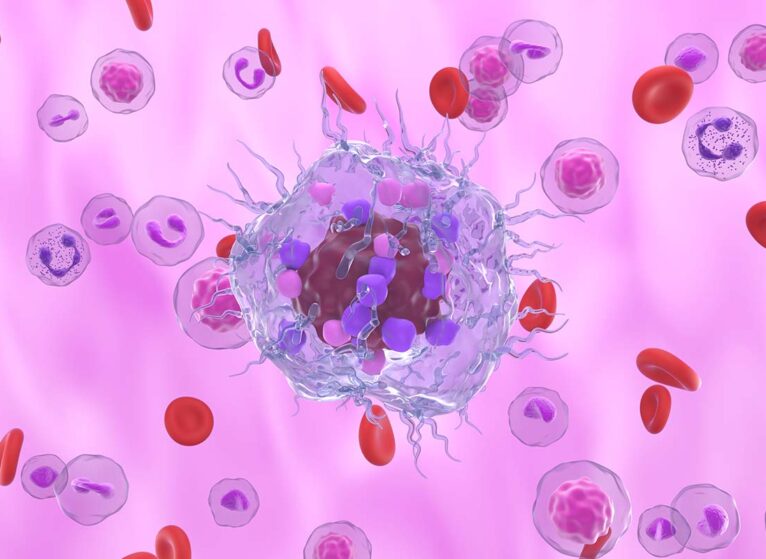 Illustration of neuroendocrine cancer