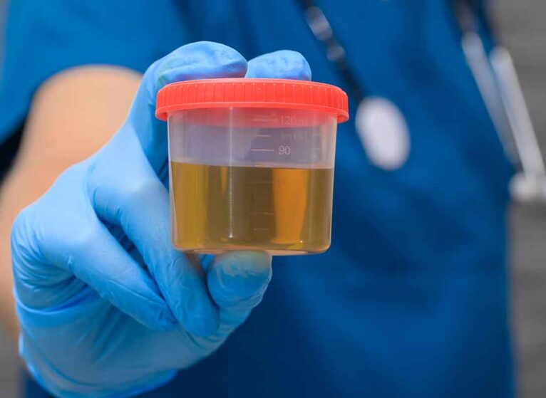 A dr holds a sample of urine to test for a UTI.