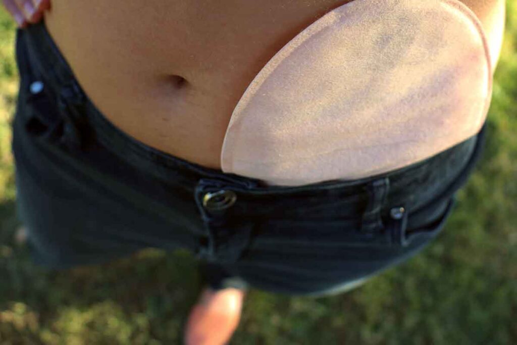What is ostomy? A colostomy in a pair of jeans