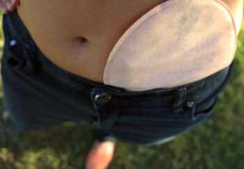 What is ostomy? A colostomy in a pair of jeans