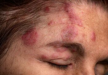 Shingles plaques show up red and painful on a person's face