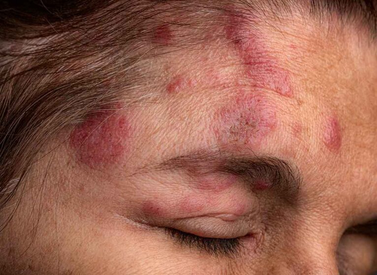 Shingles plaques show up red and painful on a person's face