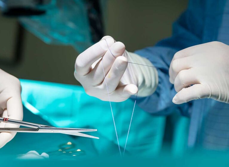 Medical stitches like these can use different materials.